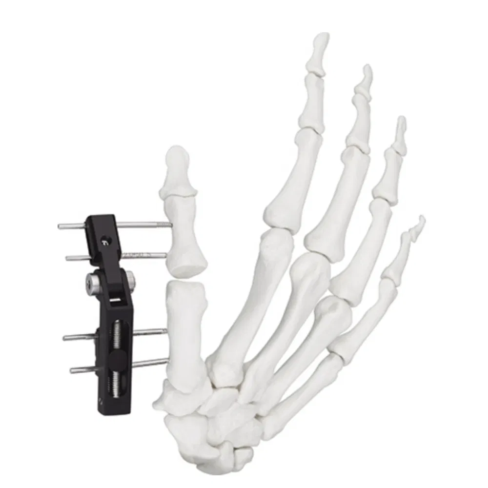External Fixator Hand Bone Pin Stent Radius Mini Fixator Track Vertical Axis Type