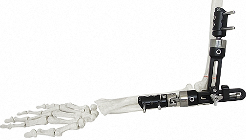 High-Quality External Fixator for Bone Fixation, White &amp; Black, Durable Materials