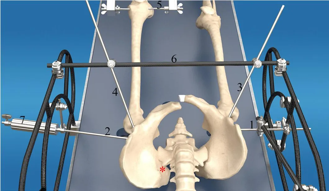 Pelvic External Fixator Detail