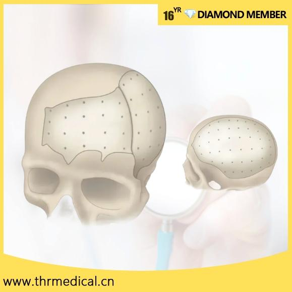 Surgical Peek Patient Specific Implant Custom Maxillofacial Repair System