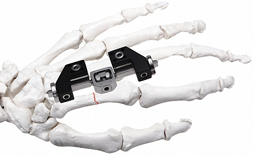 High-Quality External Fixator for Bone Fixation, White &amp; Black, Durable Materials