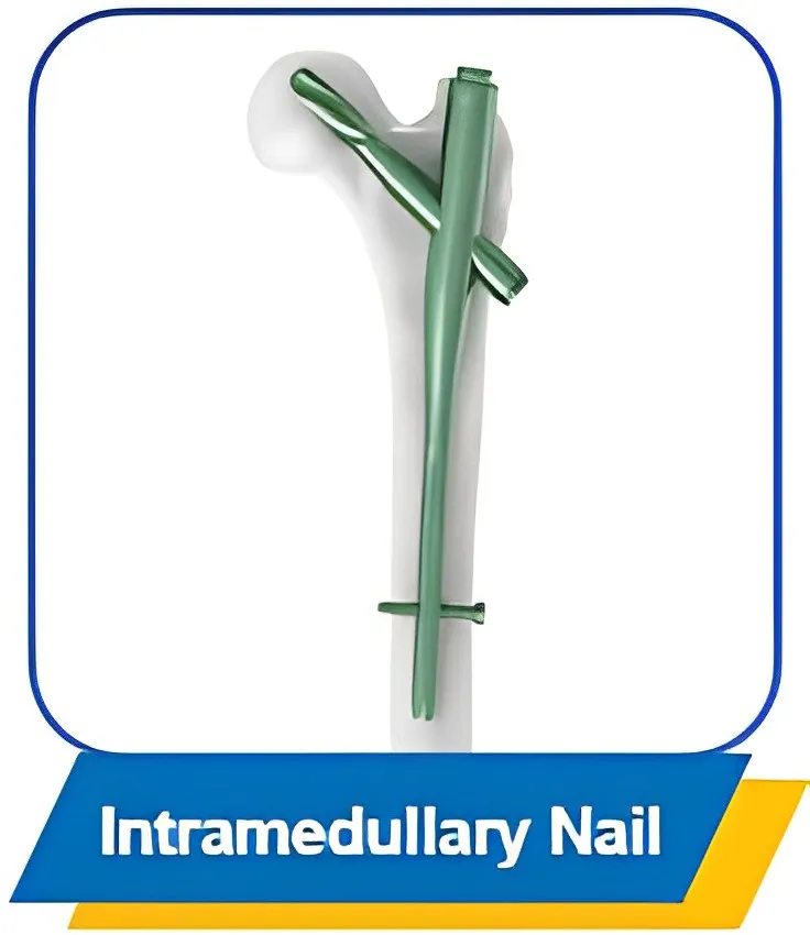 Intramedullary Nail