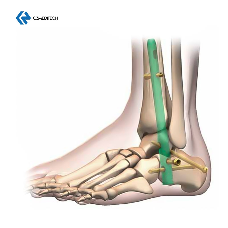 Hindfoot Fusion Ankle Intramedullary Nail Titanium Interlocking Nail Exporters Hospital Surgical Equipment