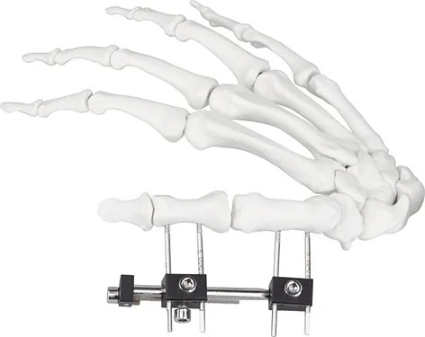 Hand Bone Pin Stent Detail 2