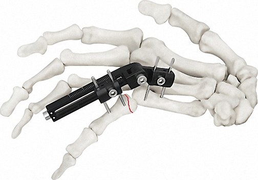 High-Quality External Fixator for Bone Fixation, White &amp; Black, Durable Materials