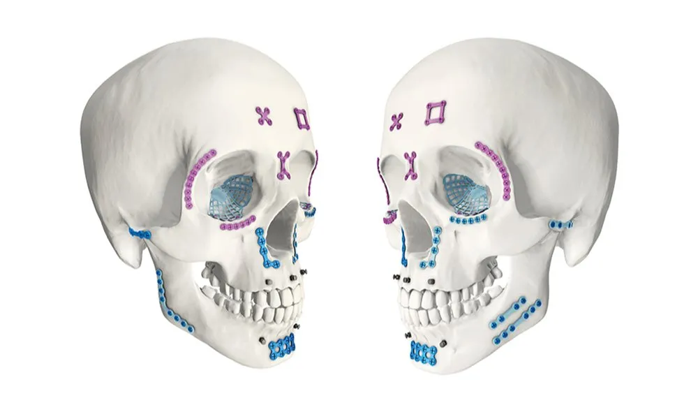 Maxillofacial Mini Plates
