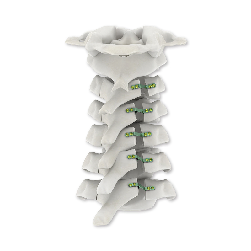 Pedicle Screw System for Spinal Fusion