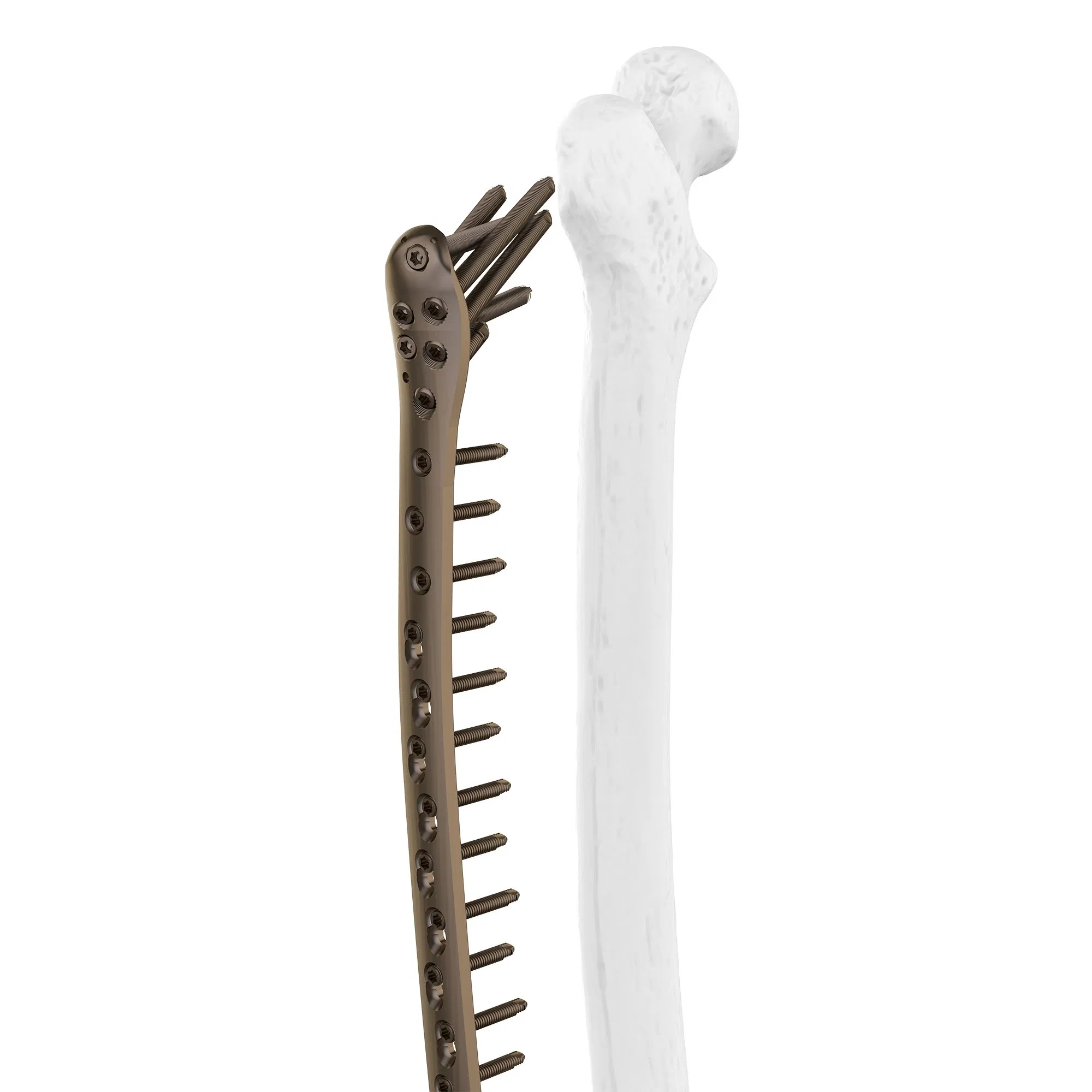 Canwell Proximal Femoral Locking Plate Femur Plate Large Fragment Femoral Plate