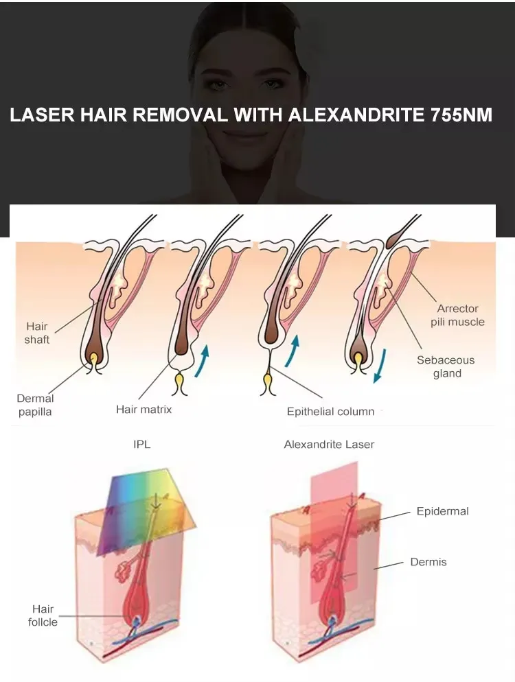 Alexandrite Laser Treatment Details
