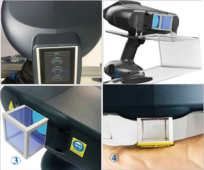 Peninsula Handheld Dermatitis Vitiligo Treating Device 308nm Excimer Laser for Vitiligo Treatment