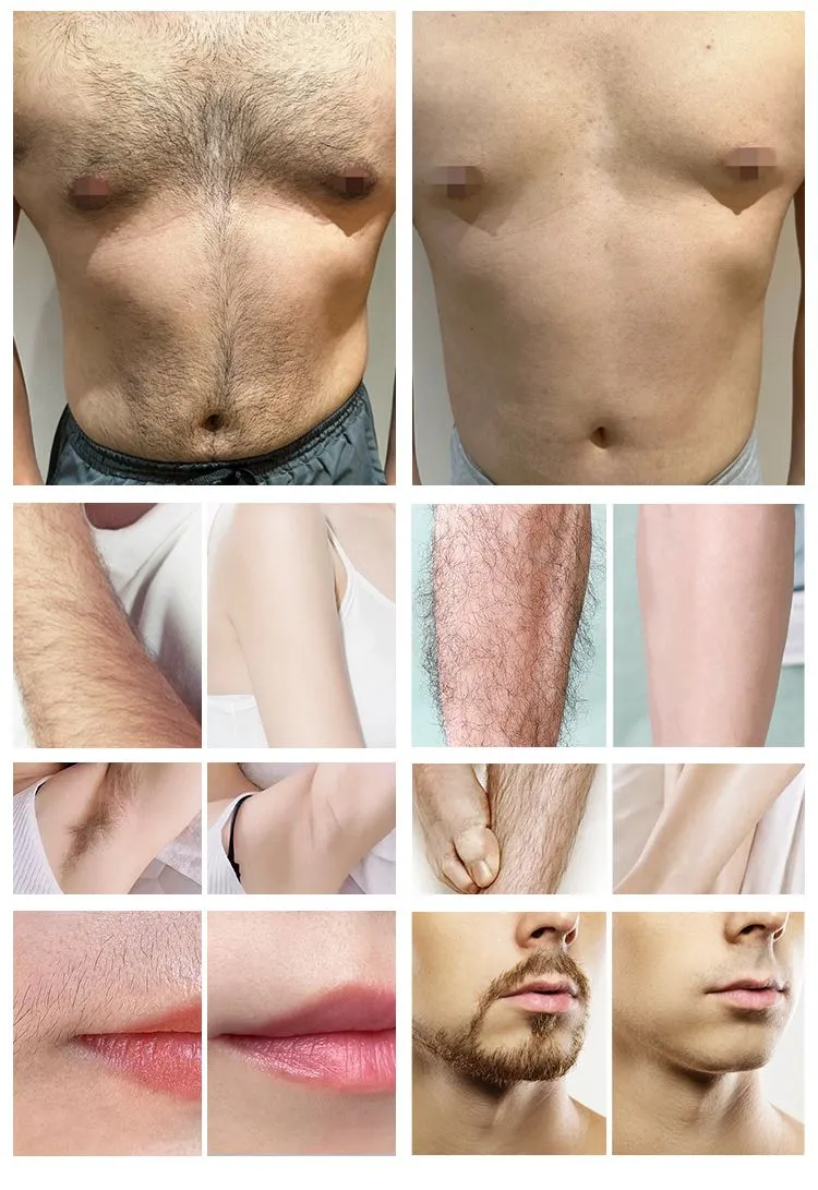 High Power Diode Laser System for Fast Hair Reduction