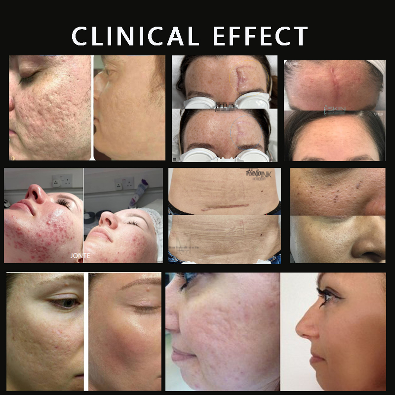 10600nm Mode System Surgical Gynecology CO2 Fractional Laser Skin Rejuvenation Acne Dermatological Carbon Dioxide LaserSystems