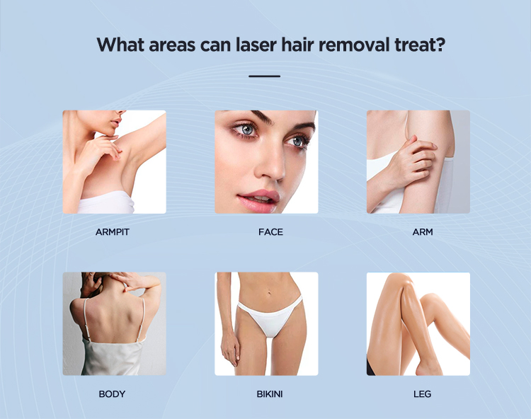 Portable 4 Wavelegths Diode Laser Hair Removal System