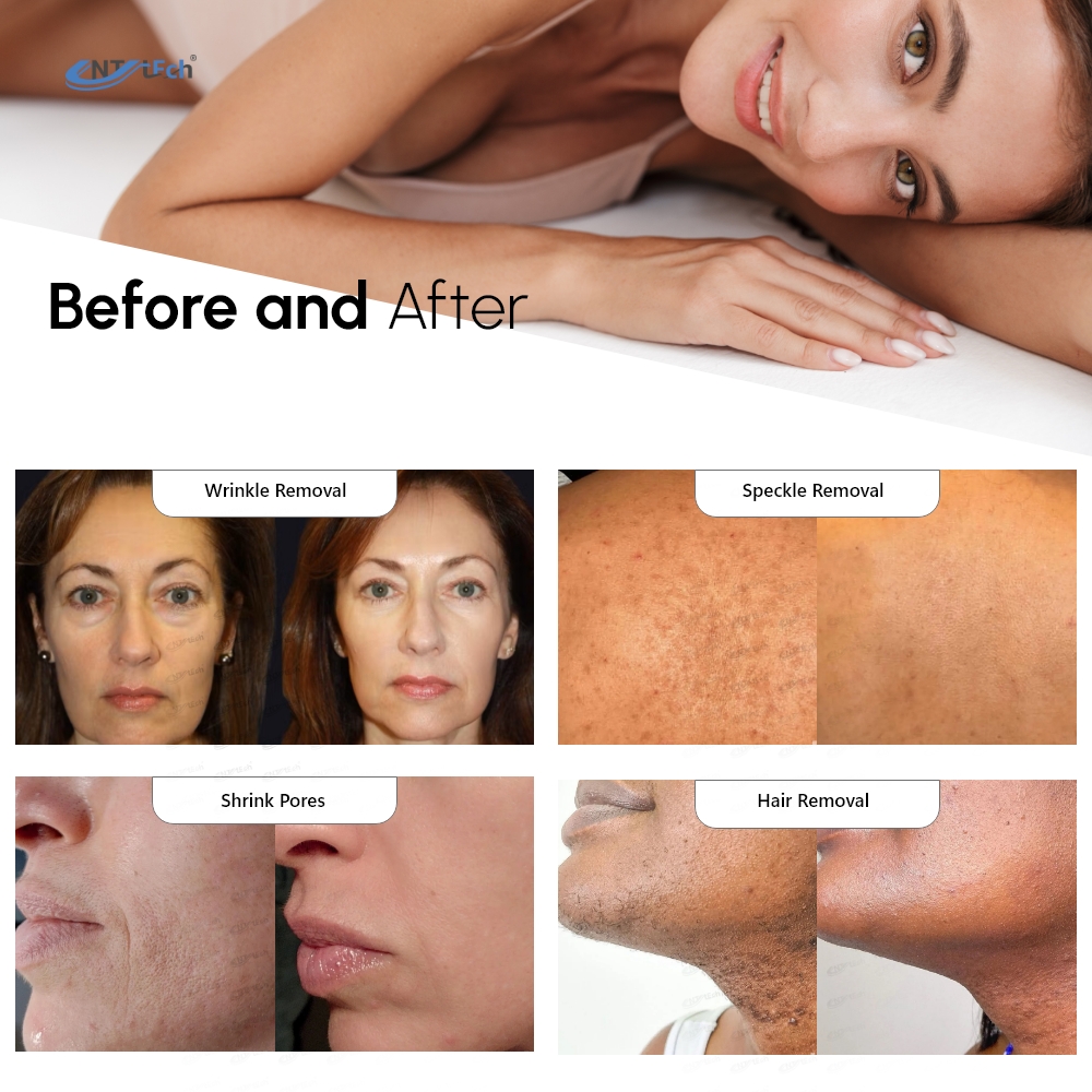 Factory Direct Delivery Alex Laser 755 1064 Long Pulse Gentle Pro Yag Laser Alexandrite Hair Removal Beauty Machine
