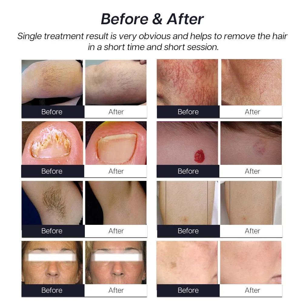 Advanced 5000W Long Pulse Laser Hair Removal System
