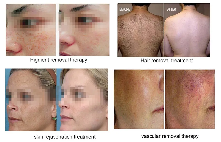 Multifunction Hair Removal Device IPL System for Permanent Hair Removal, Skin Rejuvenation, and Smooth Skin