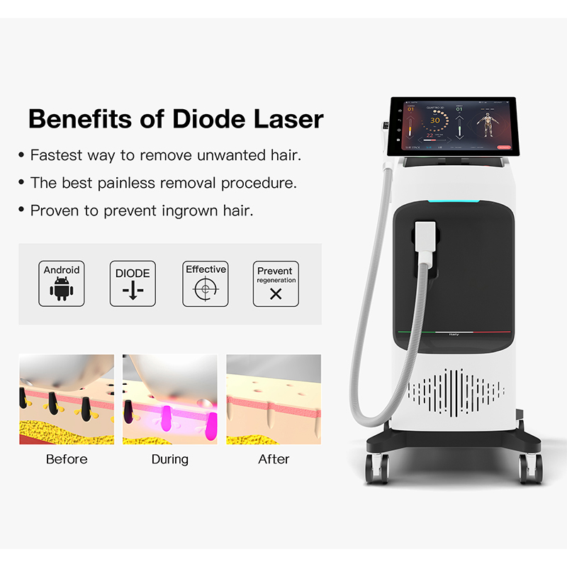 Advanced Diode Laser Hair Removal System for Safe Use