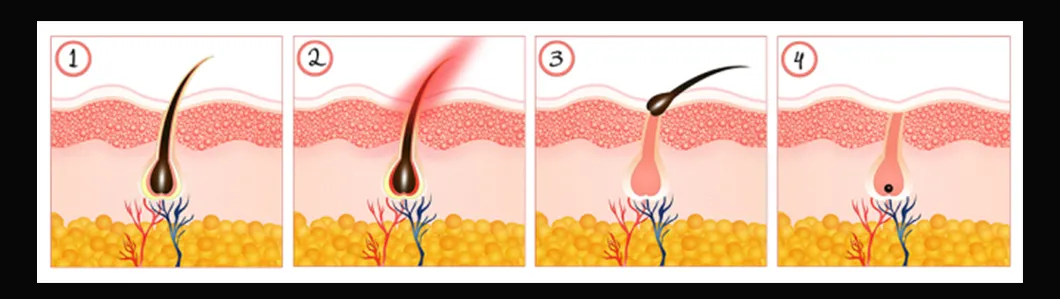 Advanced Titanium Diode Laser Hair Removal System for Beauty Salons