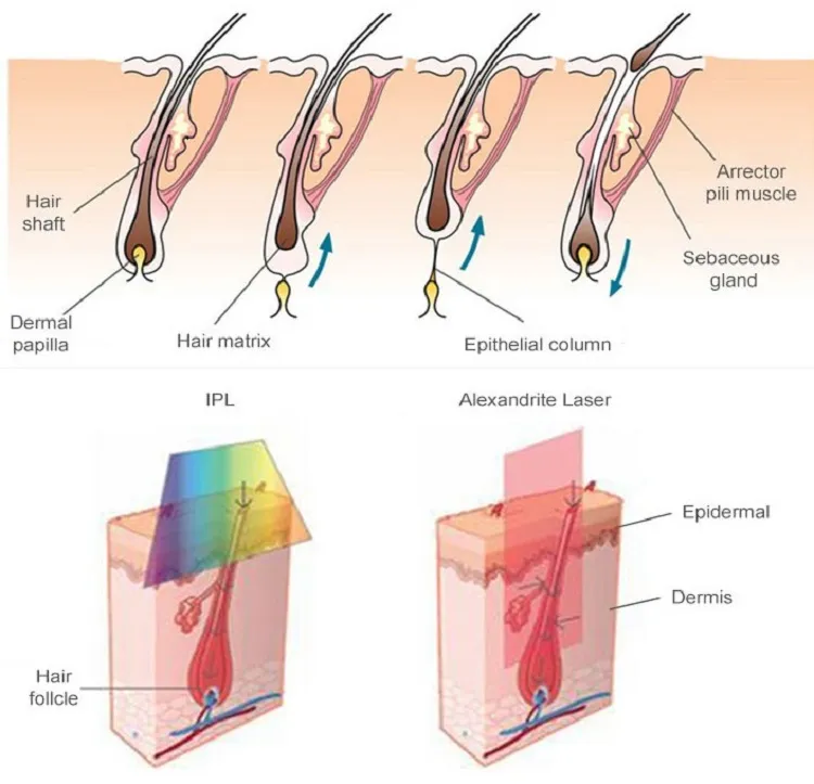 Professional Long Pulse ND YAG 755nm 1064nm Alexandrite Hair Removal Medical Laser Price
