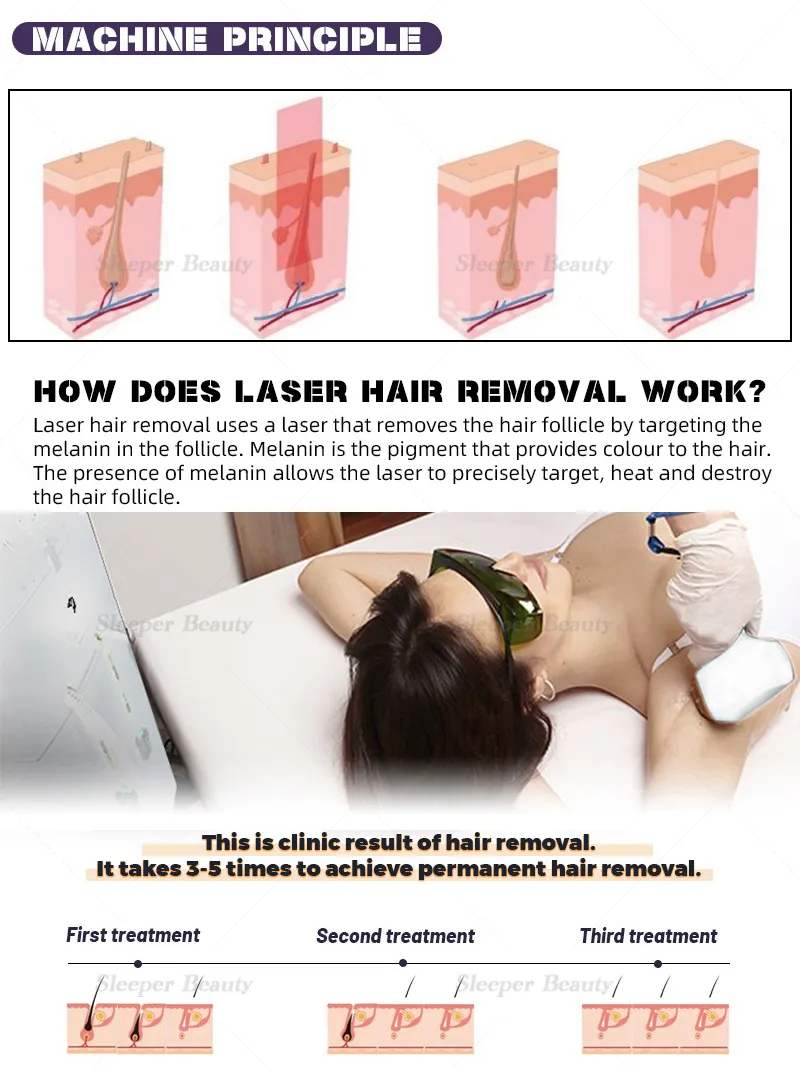Professional 808nm Diode Laser Hair Removal Machine New Tec Cooling Technology 2 Years Warranty Remote Control System