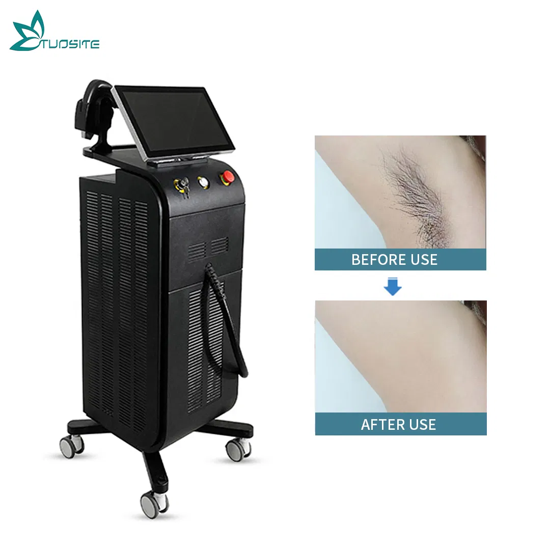 Advanced 4000W Diode Laser Hair Removal System for Smooth Skin