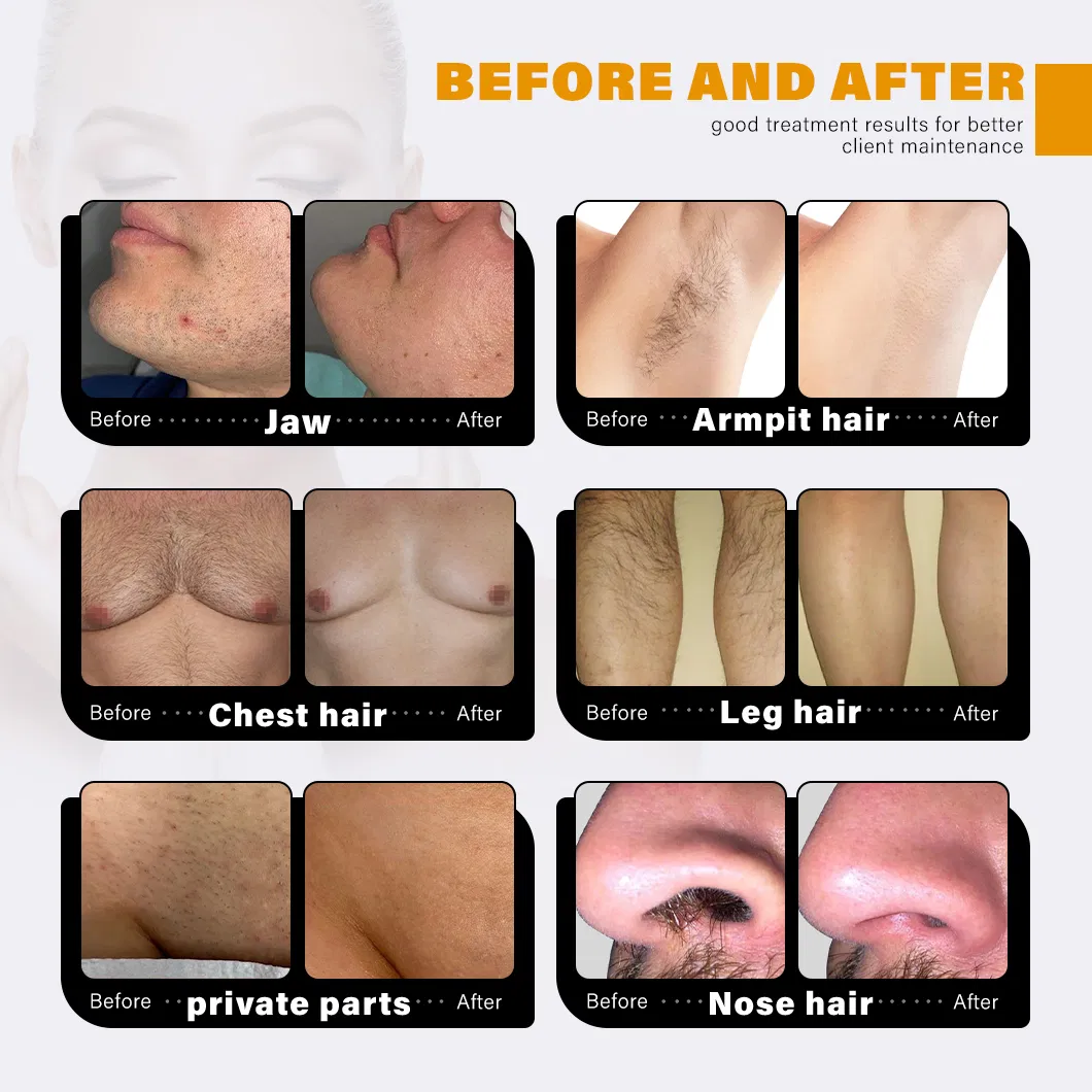 Safe Hair Removal Sopra Diode Laser Treatment Cooling System
