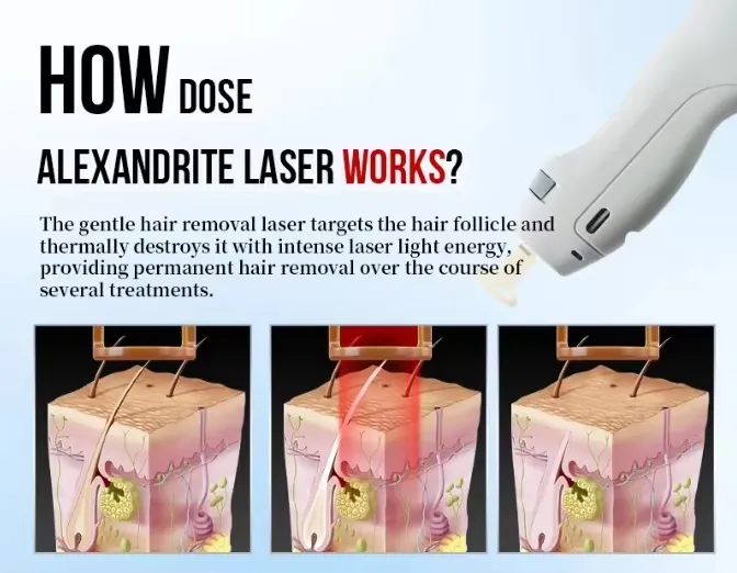755nm Alexandrite Laser Hair Removal System