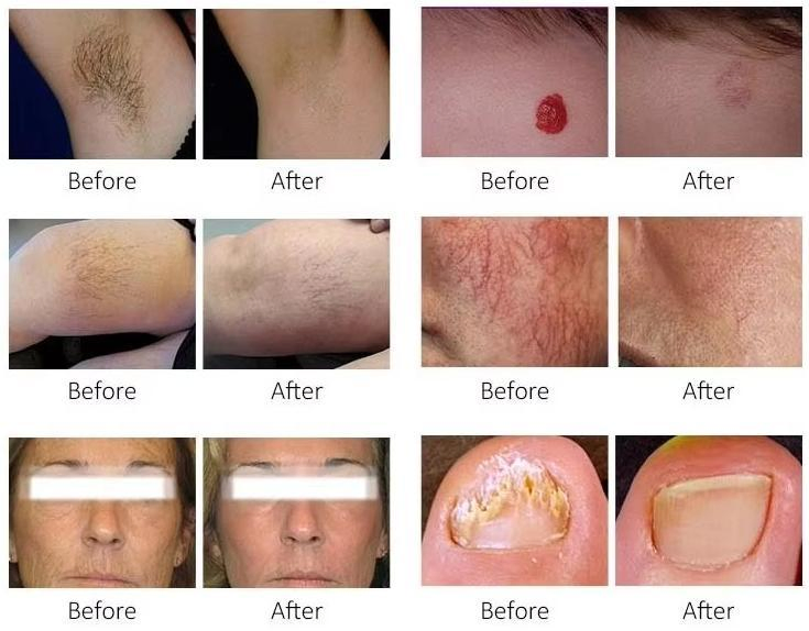 2026 New Technology Alex Laser Machine Hair Removal 755nm 1064nm Long Pulse Laser Alexandrite Laser