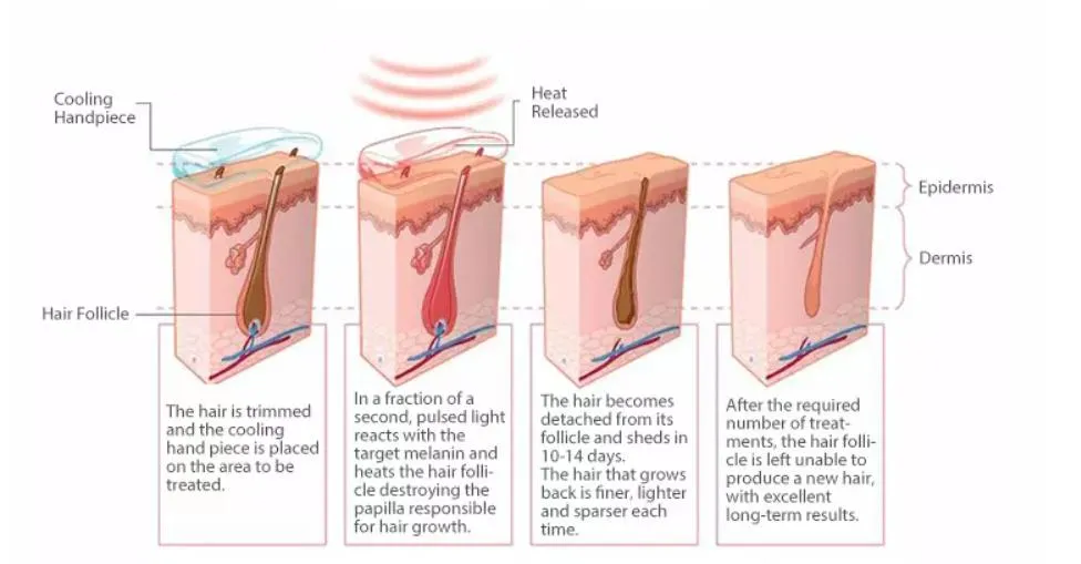 Laser Hair Removal Working Theory