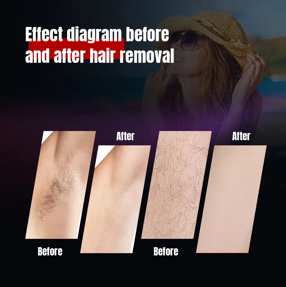 Laser Hair Removal 755nm 1064nm Long Pulse Laser Alexandrite Laser