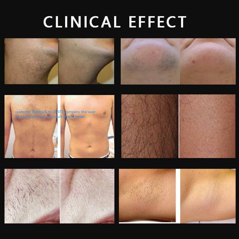 Approved MDR High 808nm Diode Laser Hair Removal Machine 755nm 808nm 940NM 1064nm Spot Sizes 1200W Home Use Body Intimate Armpit
