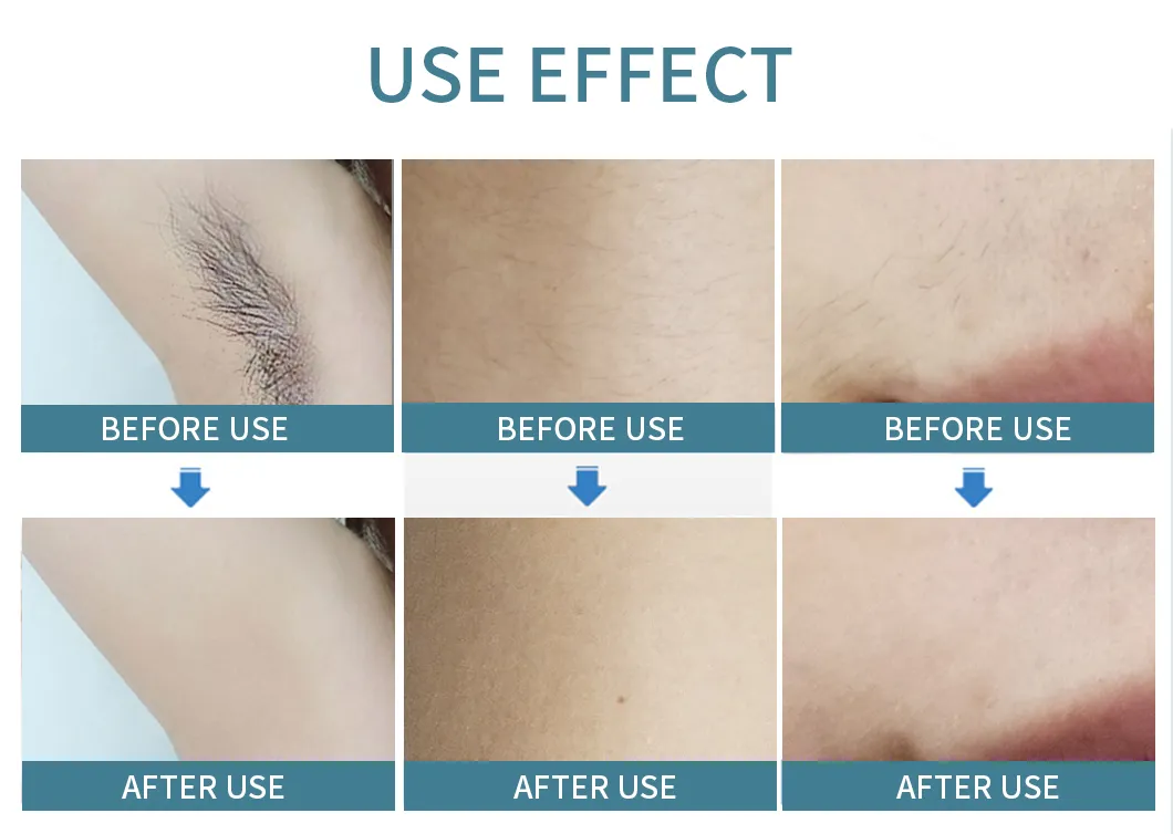 Advanced 4000W Diode Laser Hair Removal System for Smooth Skin