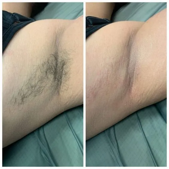 Epidermal Lesions Parameters