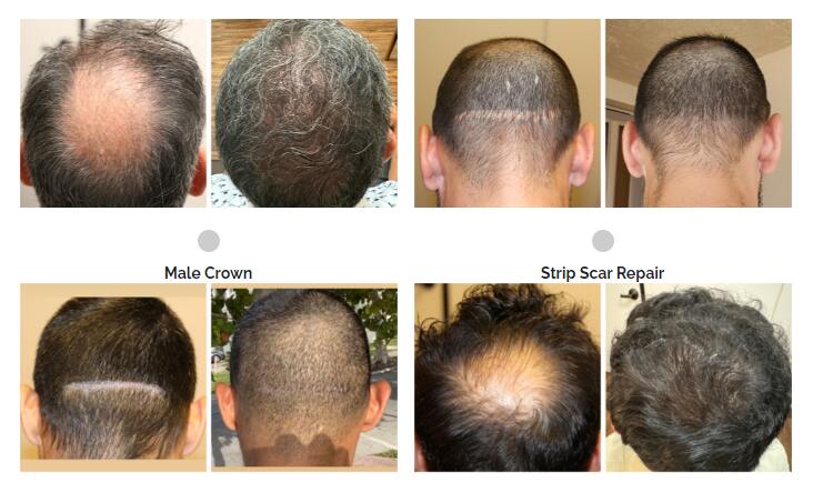 USA Approved Lllt Medical Grade Low Level Therapy 650nm Diode Laser Anti Hair Loss Treatment Hair Regrowth Laser Machine