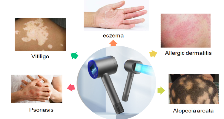 Peninsula Scalp Psoriasis Treatment Device OEM 308nm Led Red Light Therapy Device Excimer Laser Skin Care Product Machine