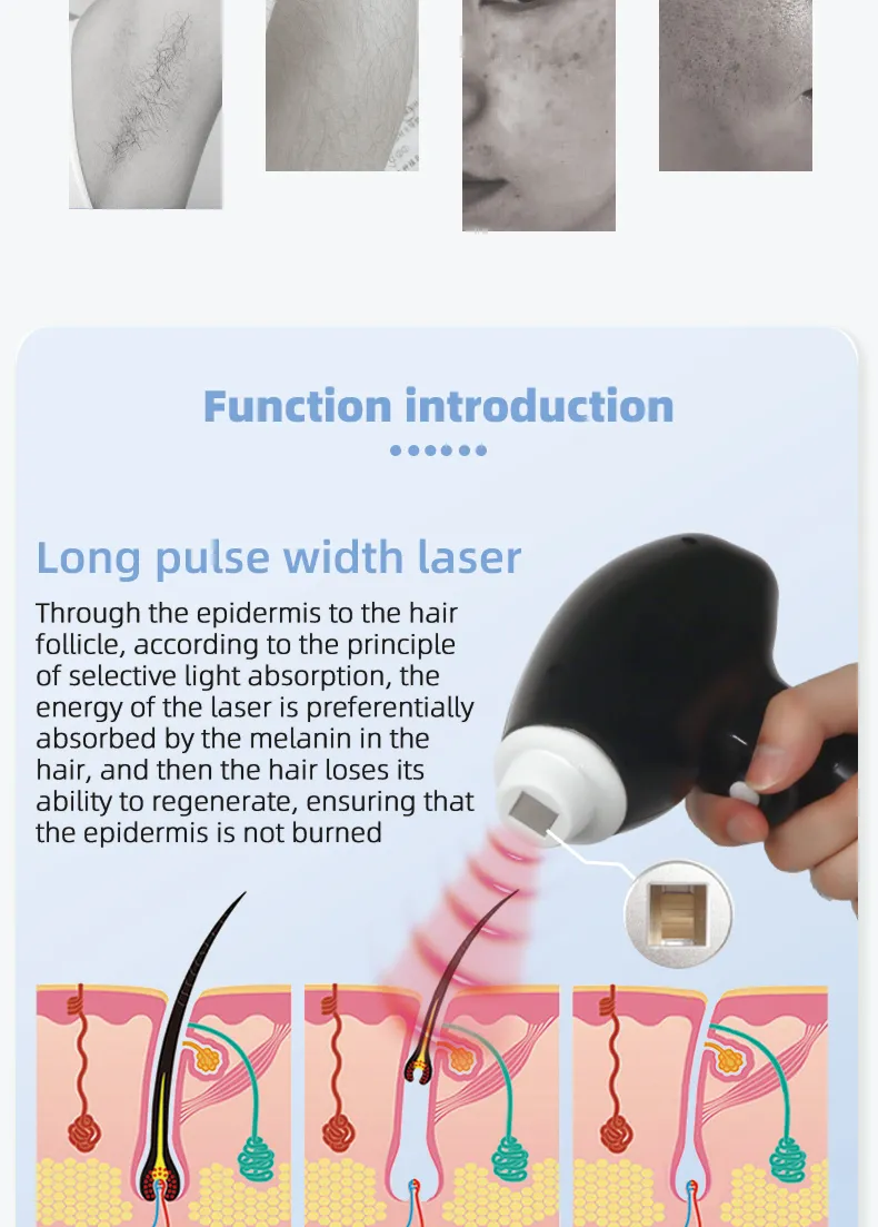 Diode Laser Hair Removal Step 3