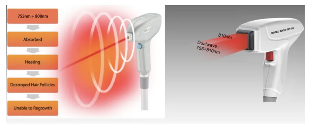 Medical 808nm Diode Laser Hair Removal Device Triple Wavelengths Diode Laser Hair Removal System