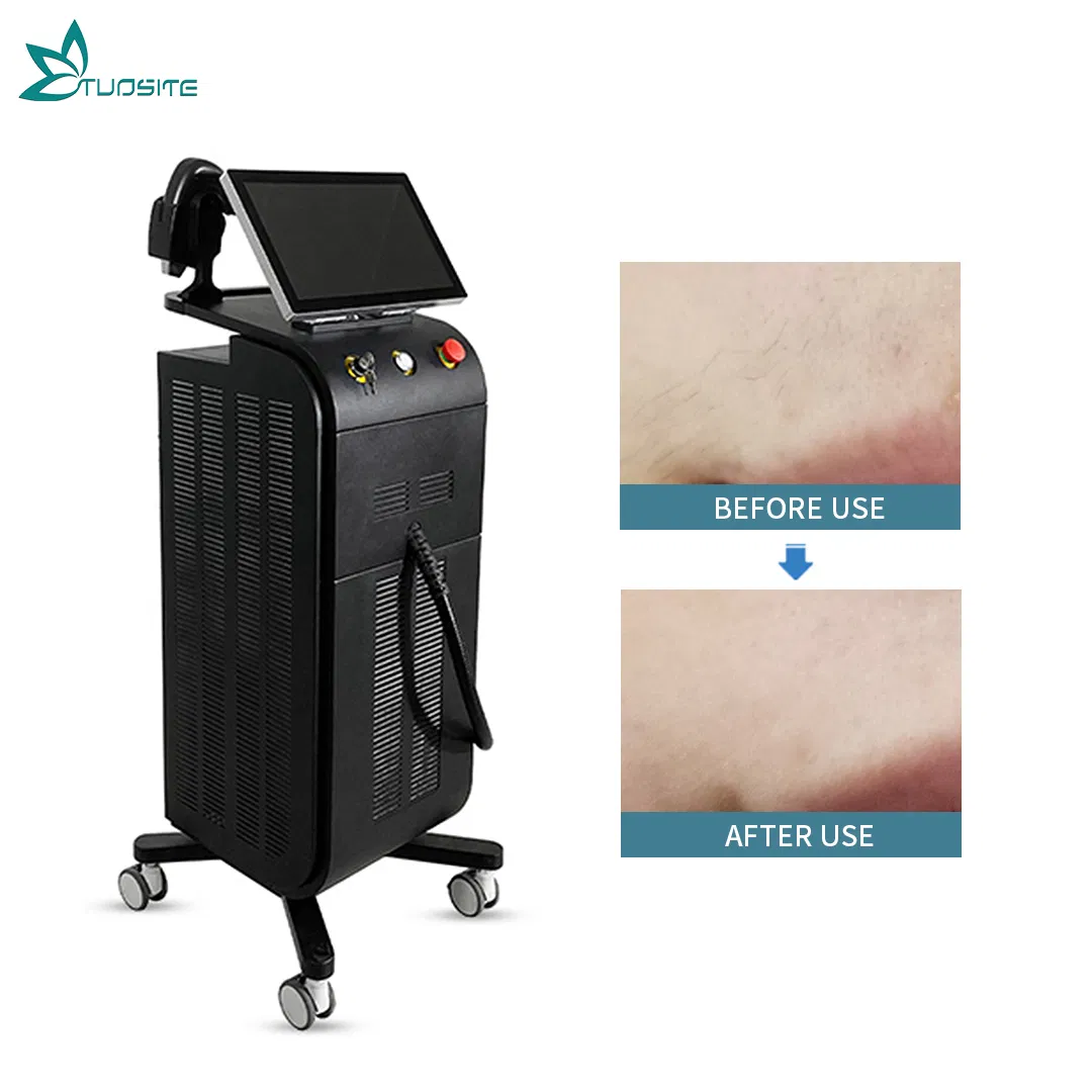 Advanced 4000W Diode Laser Hair Removal System for Smooth Skin