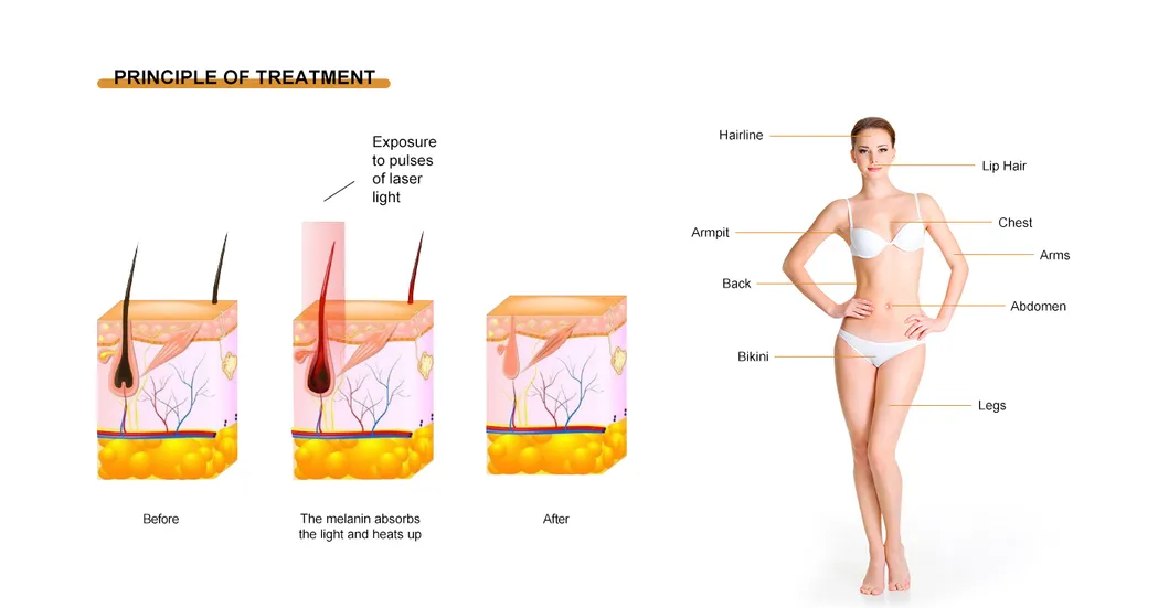 Permanent Painless Non Invasive Spare Parts Professional Alexandrite 808 Nm Diode Laser Hair Removal Machine