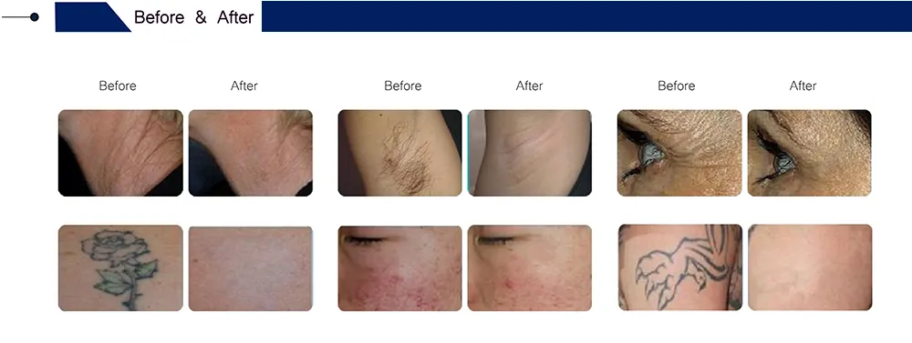 Salon Laser Machine Package Details