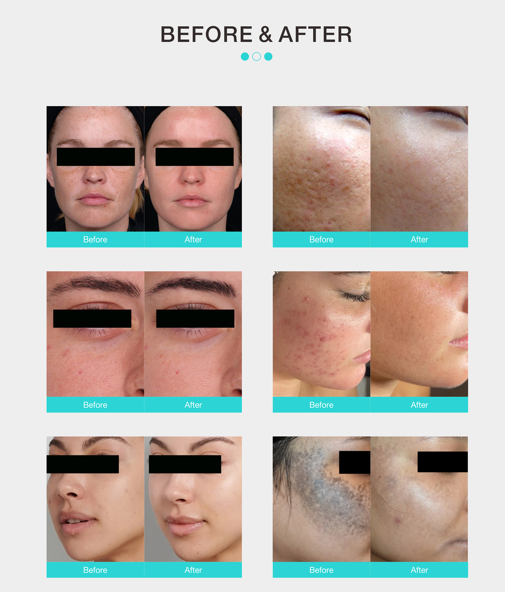 Micro-peeling 2