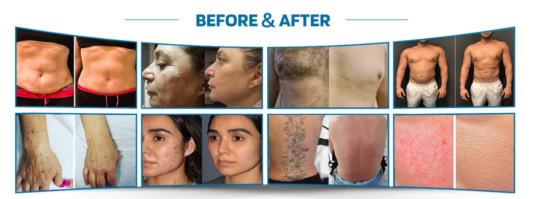 Multi Functional Diode Laser Hair Removal System Accessories