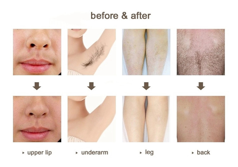 Ice Titanium Hair Removal Output Power