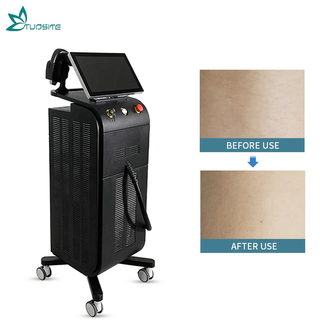 Advanced 4000W Diode Laser Hair Removal System for Smooth Skin