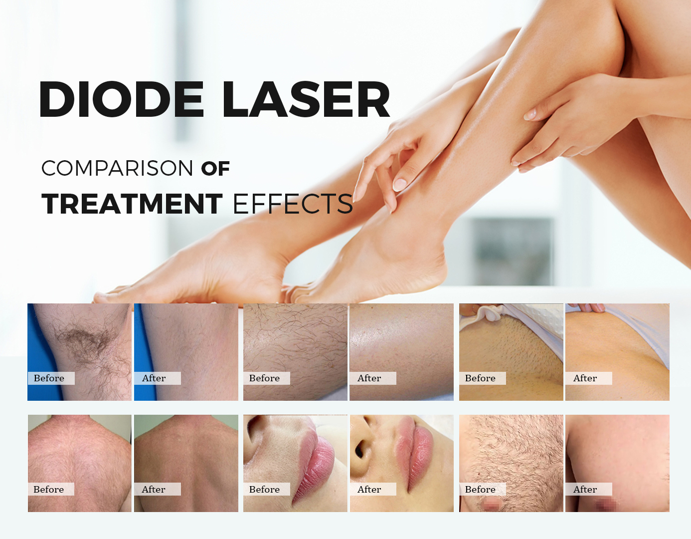 Newest 4K 4 Wavelength Diode Laser Hair Removal 755nm 808nm 1064nm Cooling Handle Diode Laser Hair Removal Machine Professional