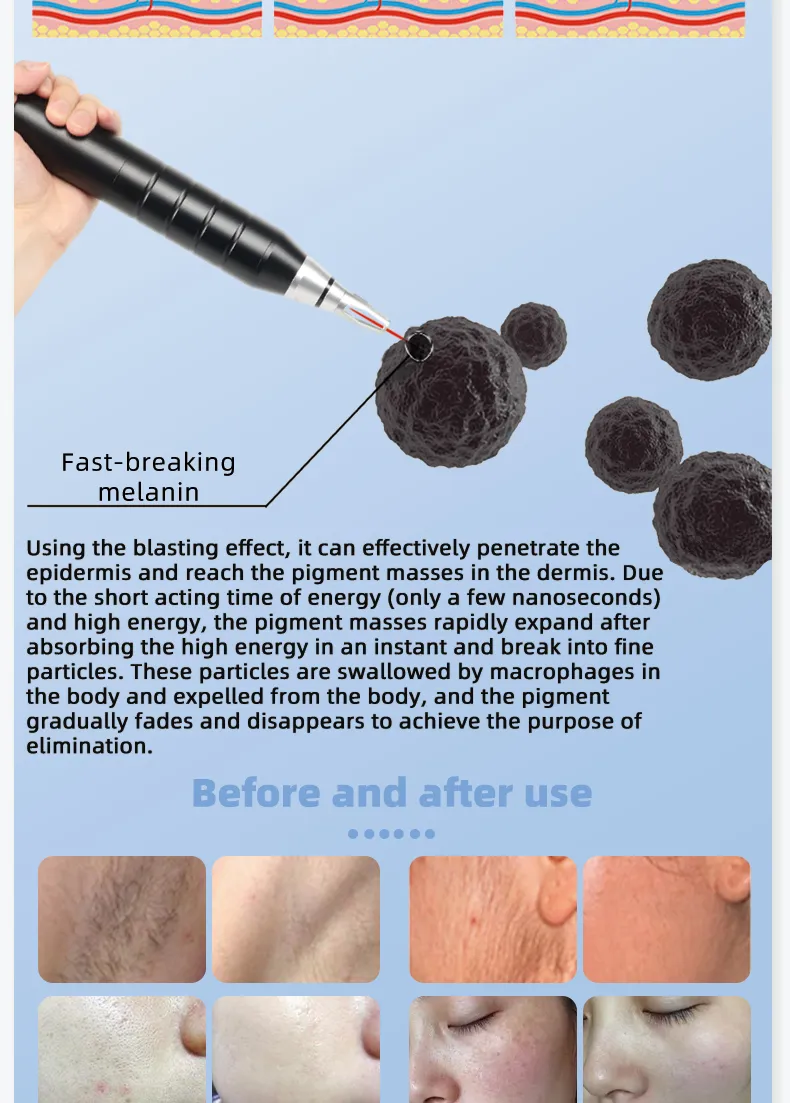 Diode Laser Hair Removal Details