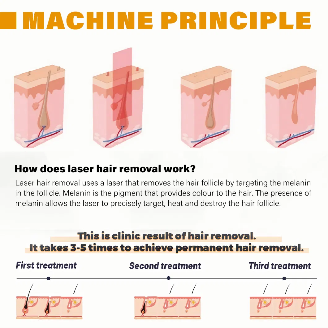 Safe Hair Removal Sopra Diode Laser Treatment Cooling System