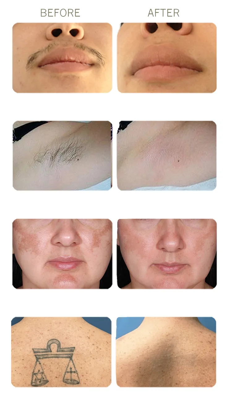 Applications and treatment zones of diode laser hair removal