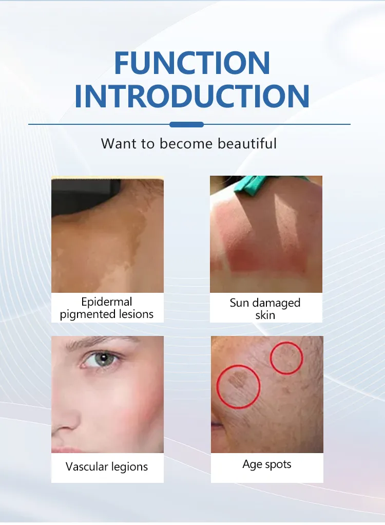 755nm Alexandrite Laser Hair Removal - Advanced Pulsed Alexandrite Technology