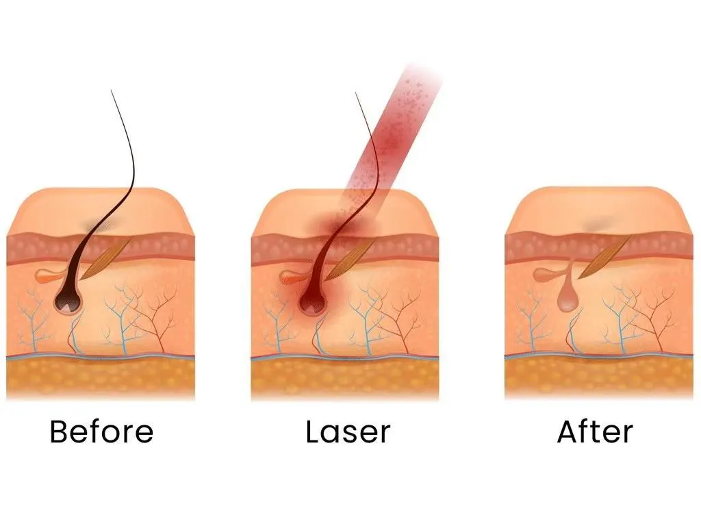 Laser Hair Removal Technology